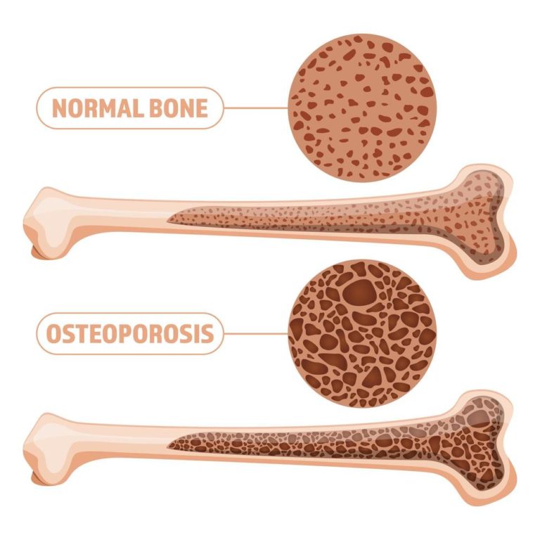 Calcium & Osteoporosis Healthy Smart Life